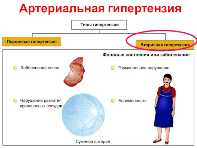 Артериальная гипертензия