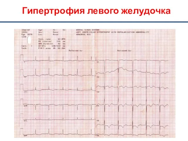 Гипертрофия левого желудочка