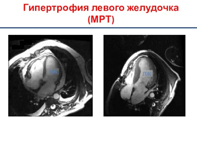 Нормальное сердце Гипертрофия левого желудочка ЛЖ ЛЖ Гипертрофия левого желудочка (МРТ)