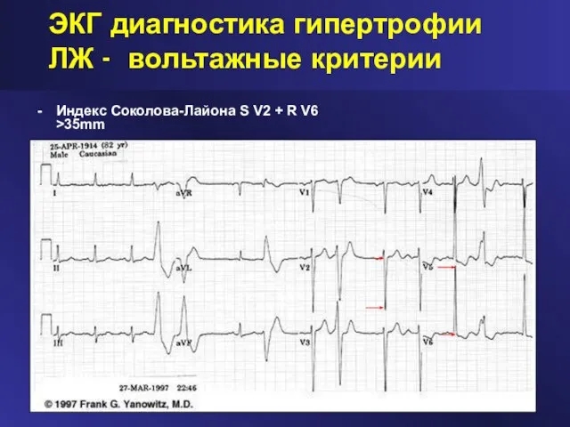 ЭКГ диагностика гипертрофии ЛЖ - вольтажные критерии Индекс Соколова-Лайона S V2 + R V6 >35mm