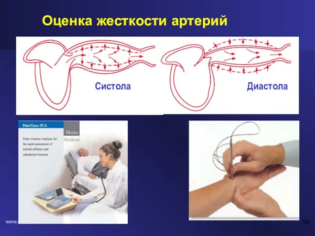 www.drsarma.in Оценка жесткости артерий