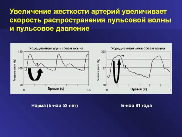 Норма (б-ной 52 лет) Б-ной 81 года Увеличение жесткости артерий увеличивает скорость