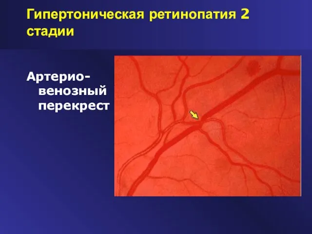 Гипертоническая ретинопатия 2 стадии Артерио-венозный перекрест