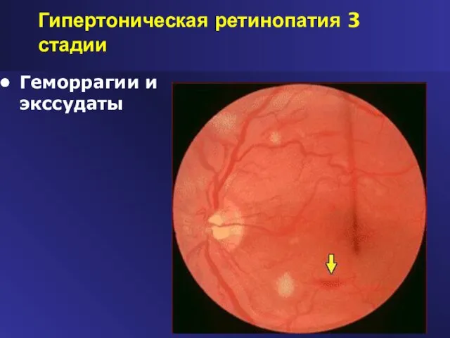 Гипертоническая ретинопатия 3 стадии Геморрагии и экссудаты