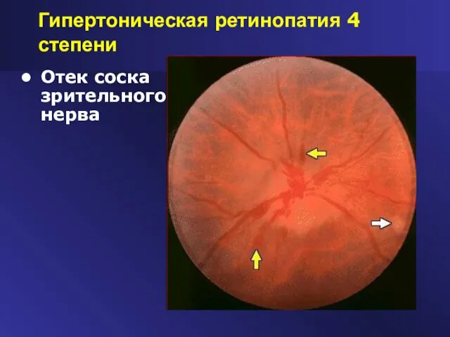 Гипертоническая ретинопатия 4 степени Отек соска зрительного нерва