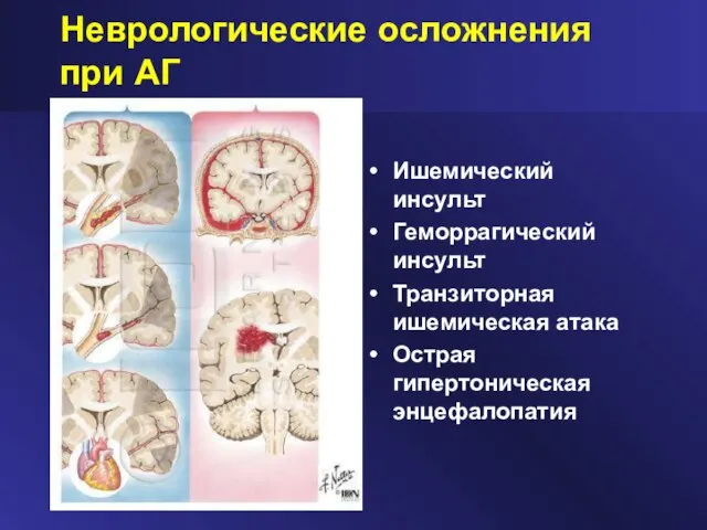 Неврологические осложнения при АГ Ишемический инсульт Геморрагический инсульт Транзиторная ишемическая атака Острая гипертоническая энцефалопатия
