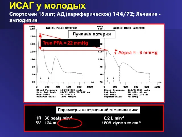 ИСАГ у молодых Спортсмен 18 лет; АД (переферическое) 144/72; Лечение - амлодипин Radial134/80 Aorta 112/81