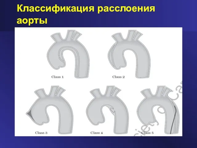 Классификация расслоения аорты