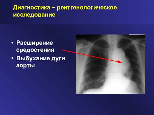 Диагностика – рентгенологическое исследование Расширение средостения Выбухание дуги аорты