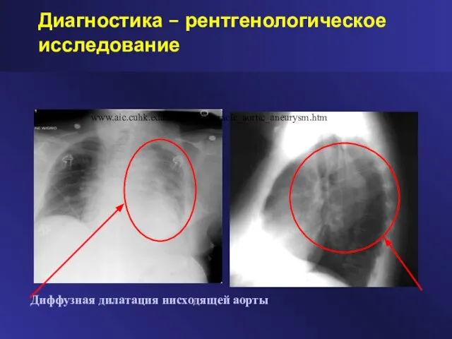 Диагностика – рентгенологическое исследование Диффузная дилатация нисходящей аорты www.aic.cuhk.edu.hk/web8/thoracic_aortic_aneurysm.htm