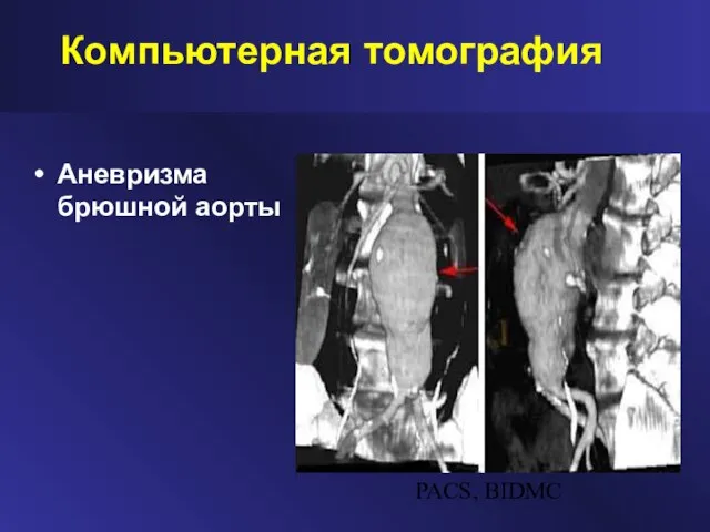 Компьютерная томография Аневризма брюшной аорты PACS, BIDMC