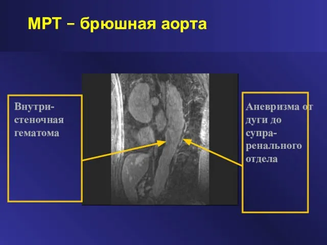 МРТ – брюшная аорта Аневризма от дуги до супра-ренального отдела Внутри-стеночная гематома