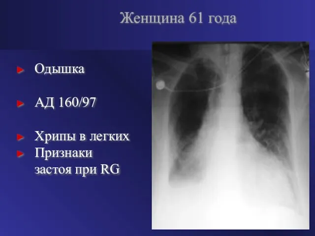 Одышка АД 160/97 Хрипы в легких Признаки застоя при RG Женщина 61 года