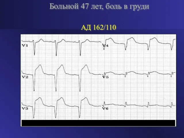 Больной 47 лет, боль в груди АД 162/110