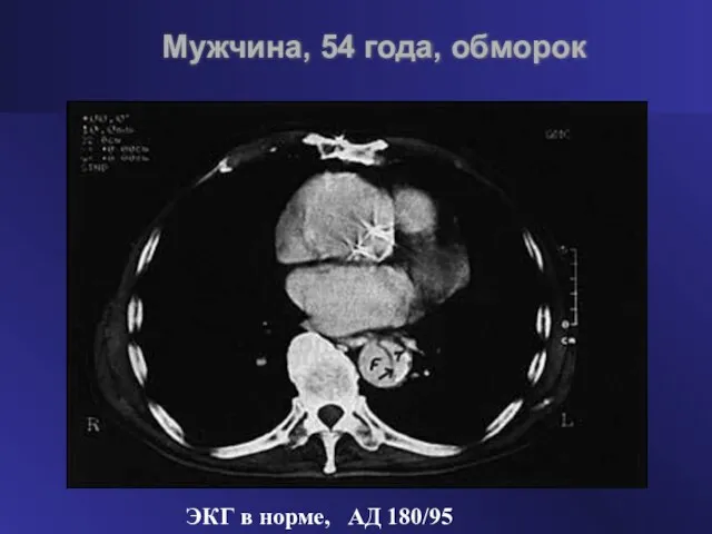 ЭКГ в норме, АД 180/95 Мужчина, 54 года, обморок