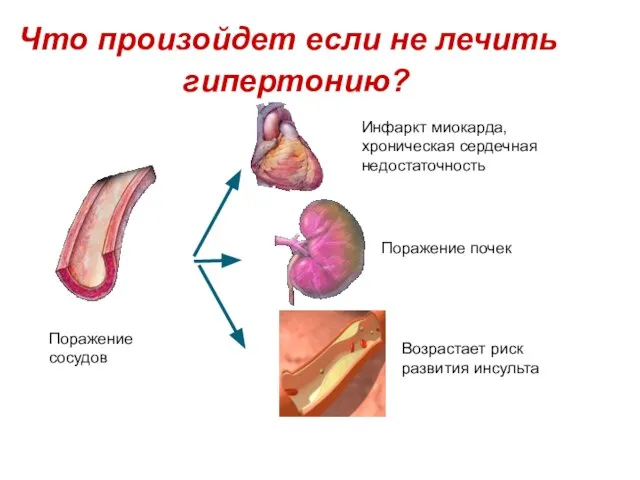 Что произойдет если не лечить гипертонию? Поражение сосудов Инфаркт миокарда, хроническая сердечная