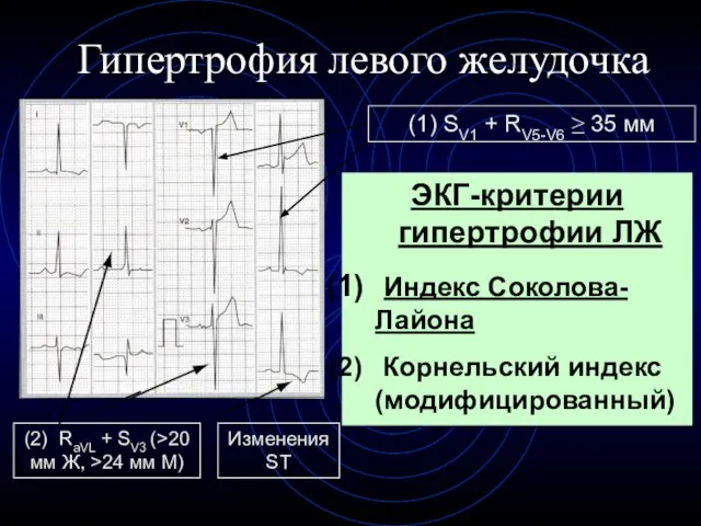 Гипертрофия левого желудочка ЭКГ-критерии гипертрофии ЛЖ Индекс Соколова-Лайона Корнельский индекс (модифицированный) (2)