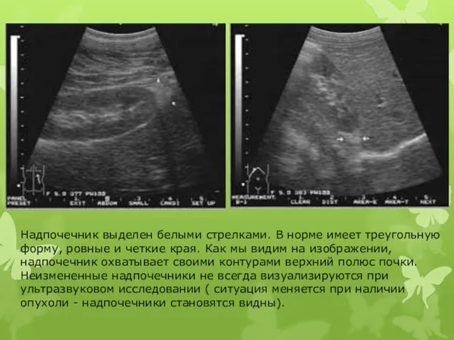Надпочечник выделен белыми стрелками. В норме имеет треугольную форму, ровные и четкие