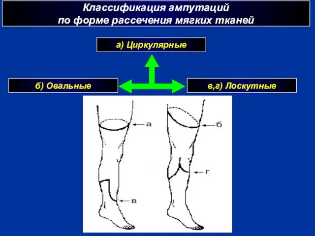 Классификация ампутаций по форме рассечения мягких тканей а) Циркулярные б) Овальные в,г) Лоскутные