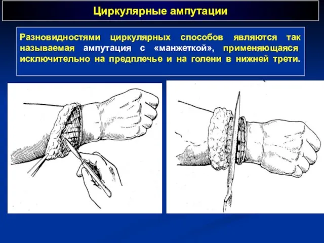 Циркулярные ампутации Разновидностями циркулярных способов являются так называемая ампутация с «манжеткой», применяющаяся