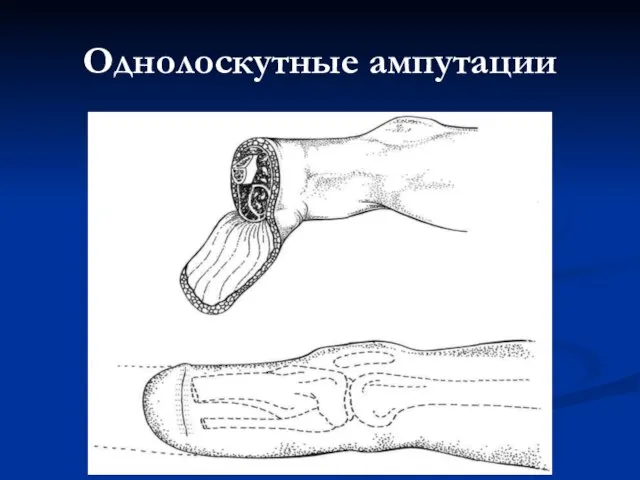 Однолоскутные ампутации