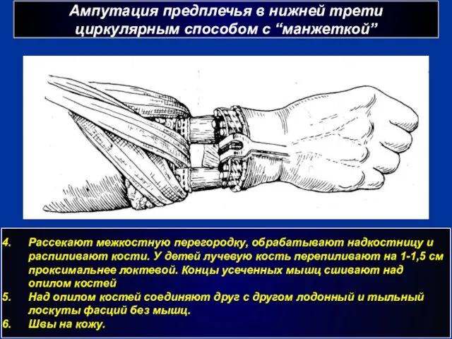 Ампутация предплечья в нижней трети циркулярным способом с “манжеткой” г Рассекают межкостную