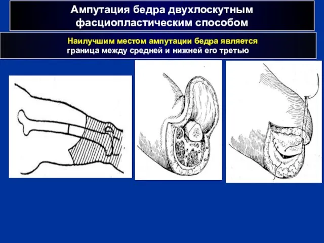 Ампутация бедра двухлоскутным фасциопластическим способом Наилучшим местом ампутации бедра является граница между