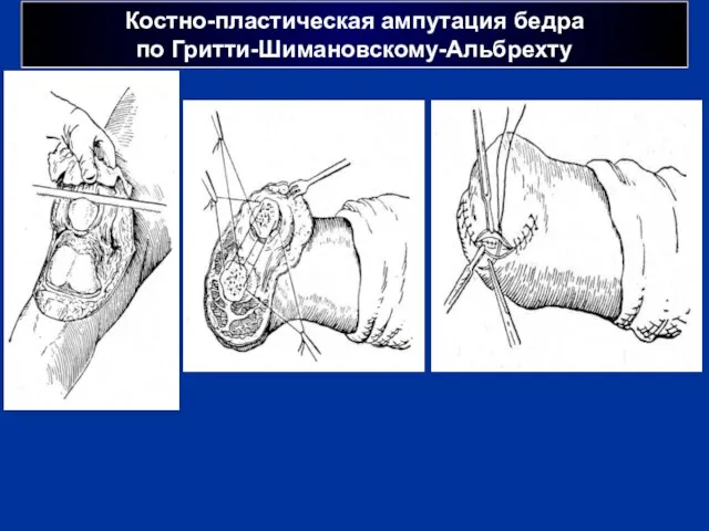 Костно-пластическая ампутация бедра по Гритти-Шимановскому-Альбрехту