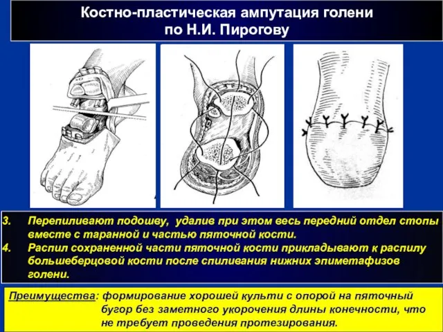 Костно-пластическая ампутация голени по Н.И. Пирогову г Перепиливают подошву, удалив при этом