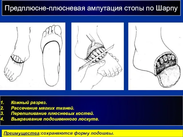 Предплюсне-плюсневая ампутация стопы по Шарпу г Кожный разрез. Рассечение мягких тканей. Перепиливание