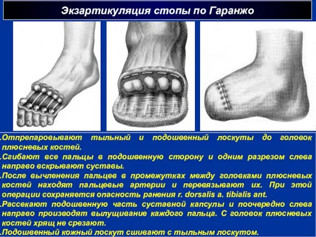 Экзартикуляция стопы по Гаранжо г Отпрепаровывают тыльный и подошвенный лоскуты до головок