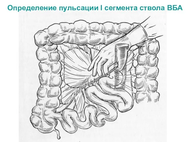 Определение пульсации I сегмента ствола ВБА