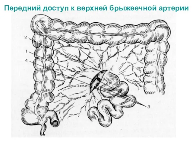 Передний доступ к верхней брыжеечной артерии