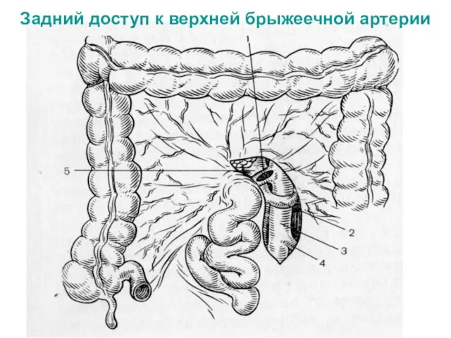 Задний доступ к верхней брыжеечной артерии