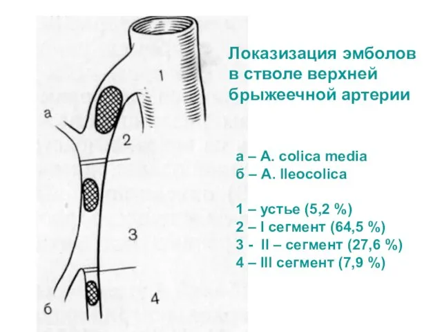 Локазизация эмболов в стволе верхней брыжеечной артерии а – A. colica media