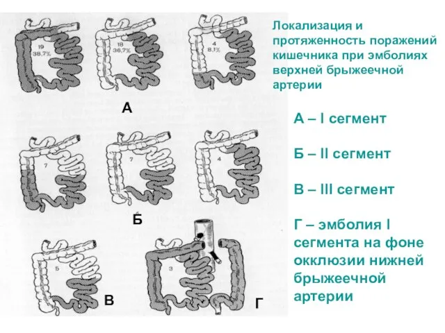 Локализация и протяженность поражений кишечника при эмболиях верхней брыжеечной артерии А Б