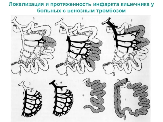 Локализация и протяженность инфаркта кишечника у больных с венозным тромбозом