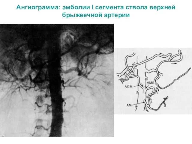 Ангиограмма: эмболии I сегмента ствола верхней брыжеечной артерии