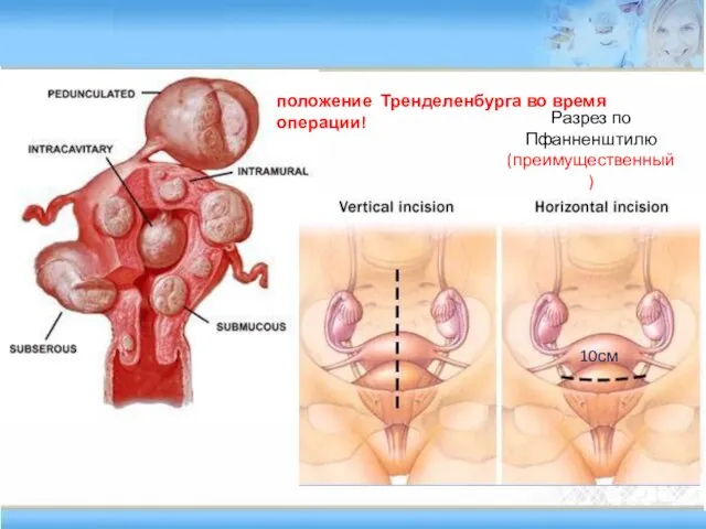 Разрез по Пфанненштилю (преимущественный) положение Тренделенбурга во время операции! 10см