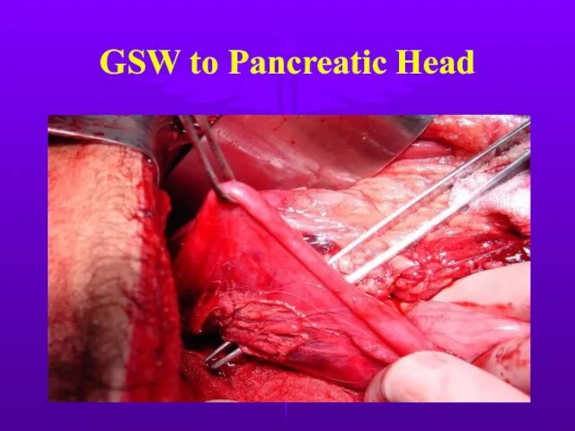 GSW to Pancreatic Head