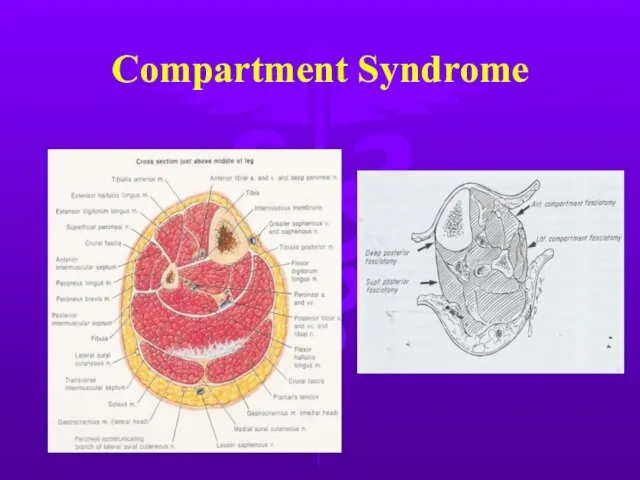 Compartment Syndrome