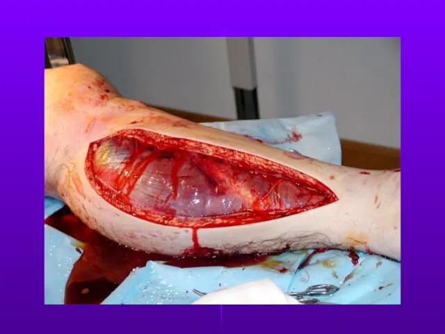 Fasciotomy