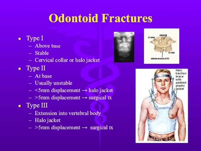 Odontoid Fractures Type I Above base Stable Cervical collar or halo jacket