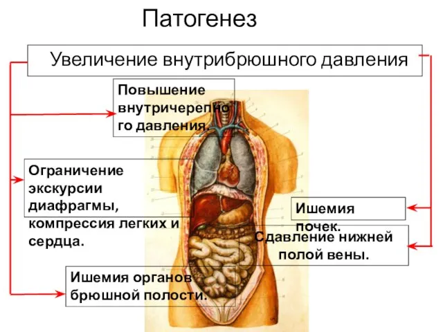 Патогенез Увеличение внутрибрюшного давления Ограничение экскурсии диафрагмы, компрессия легких и сердца. Повышение