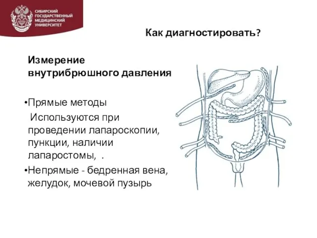 Как диагностировать? Измерение внутрибрюшного давления Прямые методы Используются при проведении лапароскопии,пункции, наличии