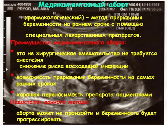 Медикаментозный аборт (фармакологический) – метод прерывания беременности на раннем сроке с помощью