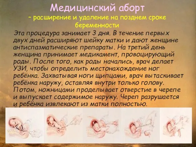 Медицинский аборт – расширение и удаление на позднем сроке беременности Эта процедура