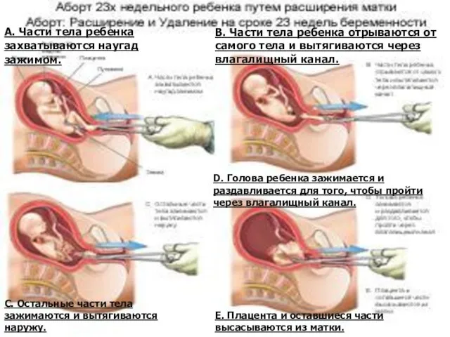 А. Части тела ребенка захватываются наугад зажимом. В. Части тела ребенка отрываются