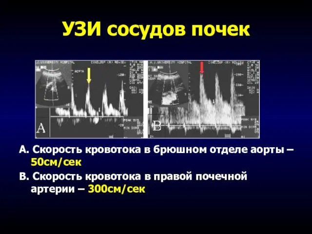 УЗИ сосудов почек А. Скорость кровотока в брюшном отделе аорты – 50см/сек