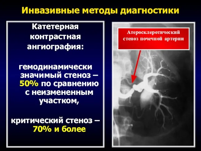 Инвазивные методы диагностики Катетерная контрастная ангиография: гемодинамически значимый стеноз – 50% по